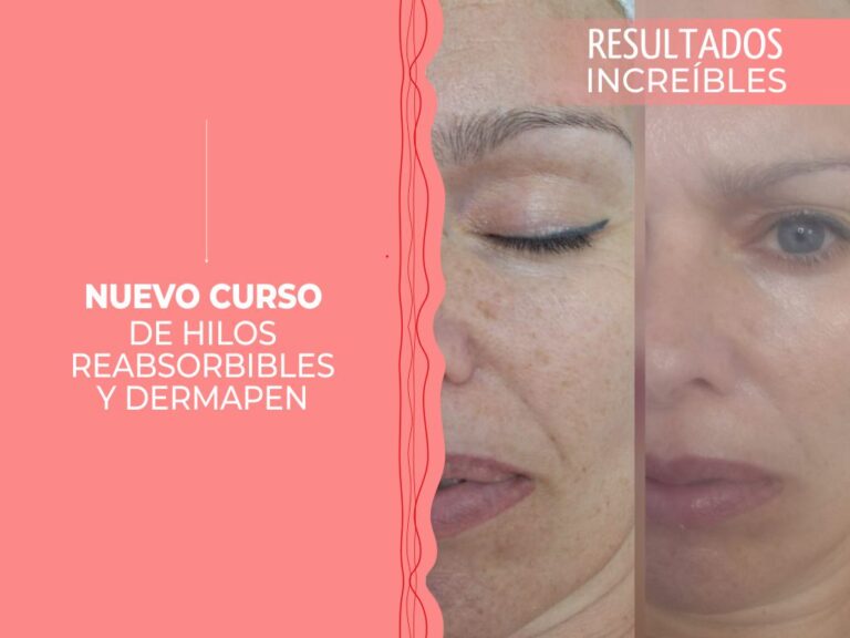 Nuevo curso de Hilos reabsorbibles y Dermapen