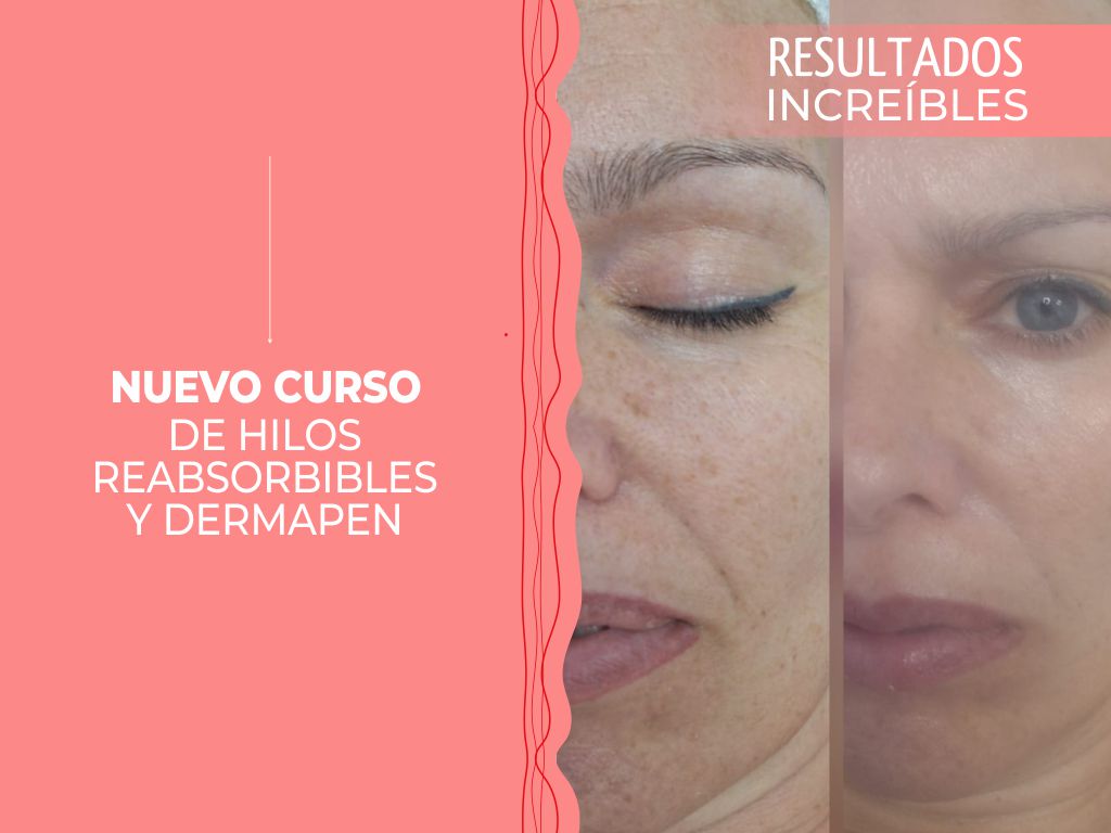 Nuevo curso de Hilos reabsorbibles y Dermapen
